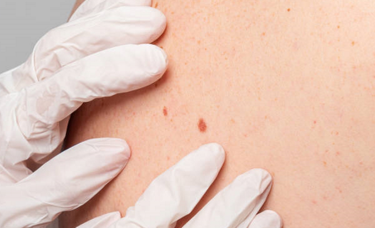 Câncer de pele: sinais de alerta e como usar a regra do ABCDE para se proteger